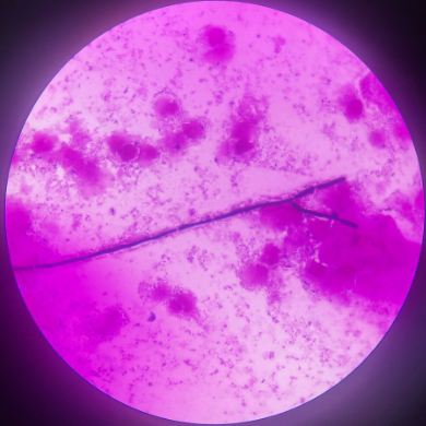 Microscopia - Candidíase mais Vaginose