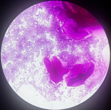 Microscopia - Vaginose Bacteriana